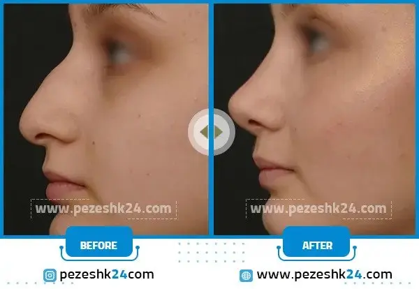 ورم نوک بینی گوشتی بعد از عمل