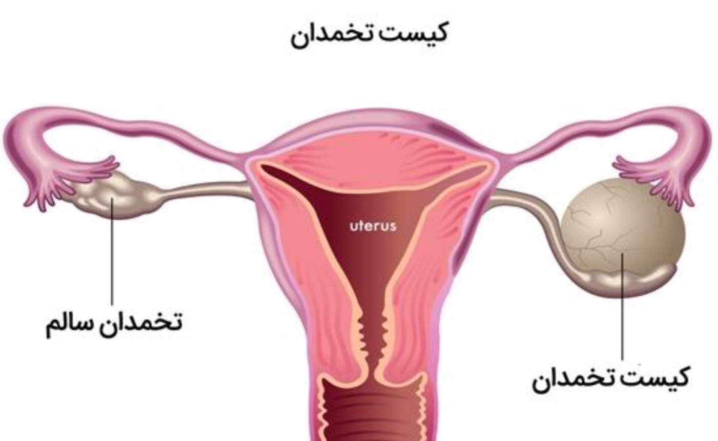 کیست تخمدان