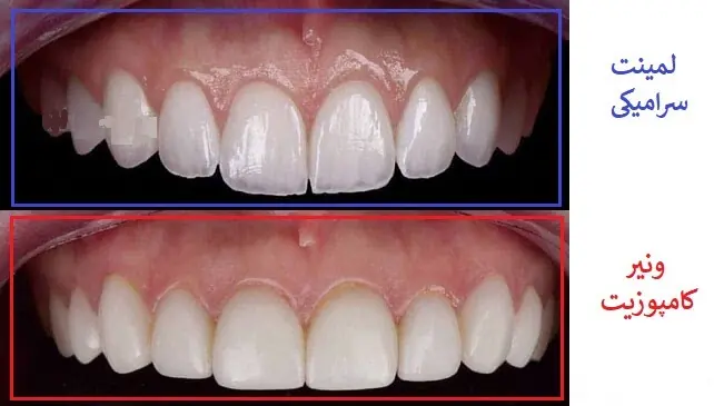 تفاوت-لمینت-و-کامپوزیت-دندان-1024x1024-1