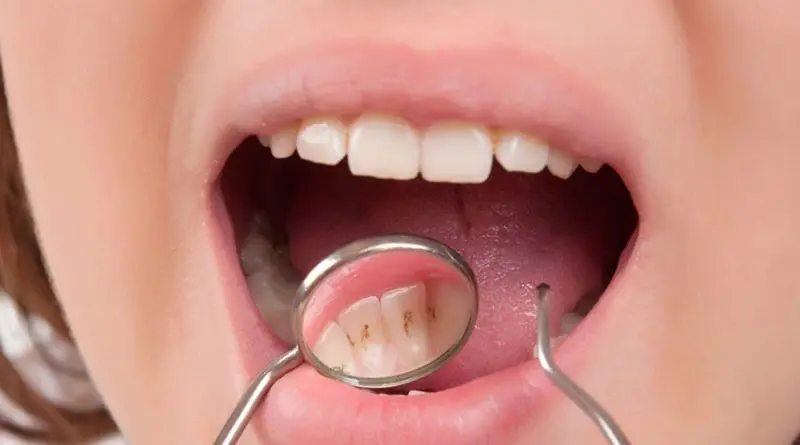 لبخندی درخشان و سفید با پیشگیری و راه های از بین بردن سیاهی دندان