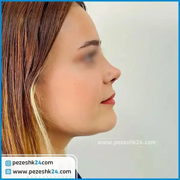 تورم نوک بینی گوشتی بعد جراحی