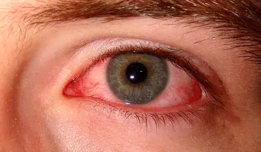 علائم بلفاریت چشم چیست؟