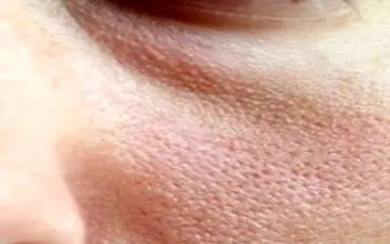  چطور می توانیم منافذ باز پوست را از بین ببریم؟
 