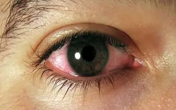 این تغییرات در چشم زنگ خطر بیماری قلبی است