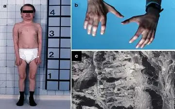 سیستینوزیس: بیماری مرموزی که اندام‌های بدن را نابود می‌کند