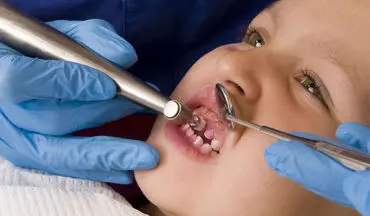 اهمیت به دندان های شیری مهم است؟