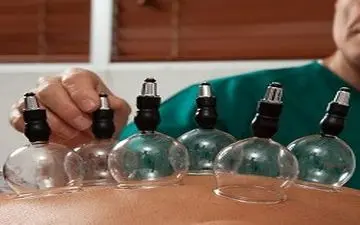 حجامت، روشی کارآمد جهت پاکسازی بدن 