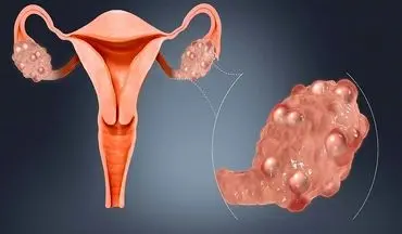 سندروم تخمدان پلی‌کیستیک را از سنین نوجوانی باید جدی بگیرید