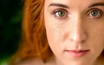 اگر کک و مک دارید بخوانید| از پوستی که کک و مک دارد باید اینگونه مراقبت کرد