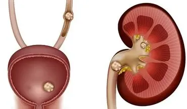 راهنمای جامع پیشگیری و درمان سنگ کلیه: از رژیم غذایی تا علائم هشداردهنده
