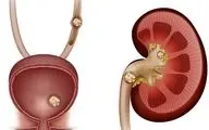 راهنمای جامع پیشگیری و درمان سنگ کلیه: از رژیم غذایی تا علائم هشداردهنده
