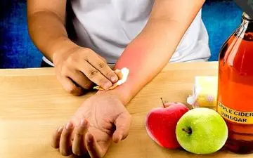 درمان سوختگی‌های سطحی در خانه / بیا بهت بگم چطوری درمان کنی!