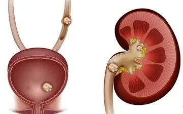 تابستان را بدون سنگ کلیه سپری کنید/ راهنمای نجات کلیه‌ها!