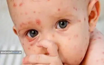 سیر صعودی ابتلا به آبله میمونی در جنوب شرق استرالیا