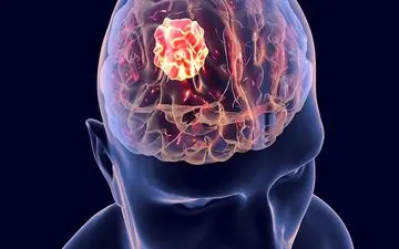 ۴ زنگ خطر برای سرطان مغز