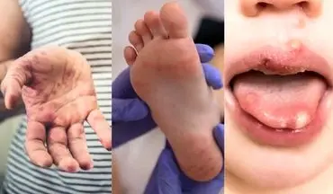 تب برفکی انسان: ویروس مسری و خطرات آن برای کودکان و بزرگسالان