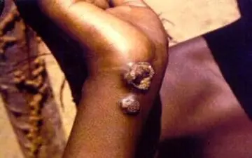  "یاز" بیماری عفونی مزمن و ناتوان کننده/این بیماری را بیشتر بشناسیم  