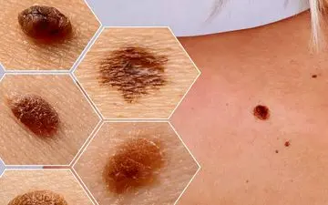 سلول‌ها ملانوسیت چیست؟ خال های خطرناک چه رنگی هستند؟