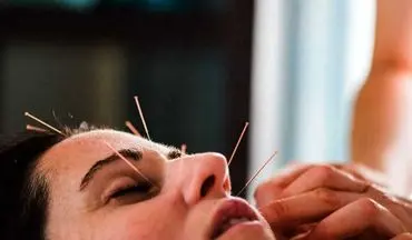 طب سوزنی صورت چگونه باعث جوان‌سازی پوست می‌شود؟