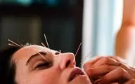 طب سوزنی صورت چگونه باعث جوان‌سازی پوست می‌شود؟