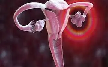 سندرم تخمدان پلی کیستیک؛ راهکارهای کنترل و درمان
