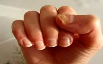 یکی از دلایل مهم عفونت قارچ ناخن چیست؟