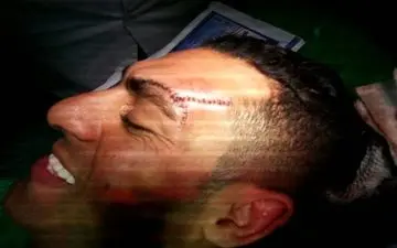  مصدومیت زهیوی مشخص شد