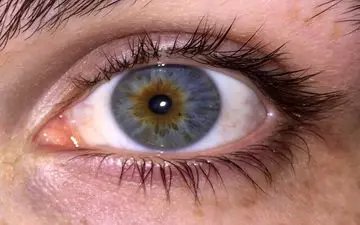 کشف پروتئینی که با نابینایی مرتبط است
