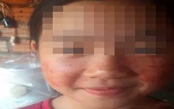 دختری که خون عرق می کند! +عکس 