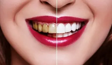 5 نکته مهم برای سفید کردن دندان‌ها
