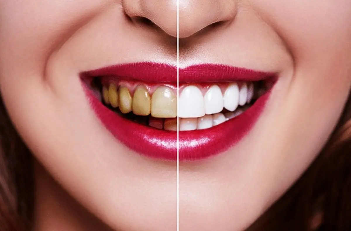 5 نکته مهم برای سفید کردن دندان‌ها