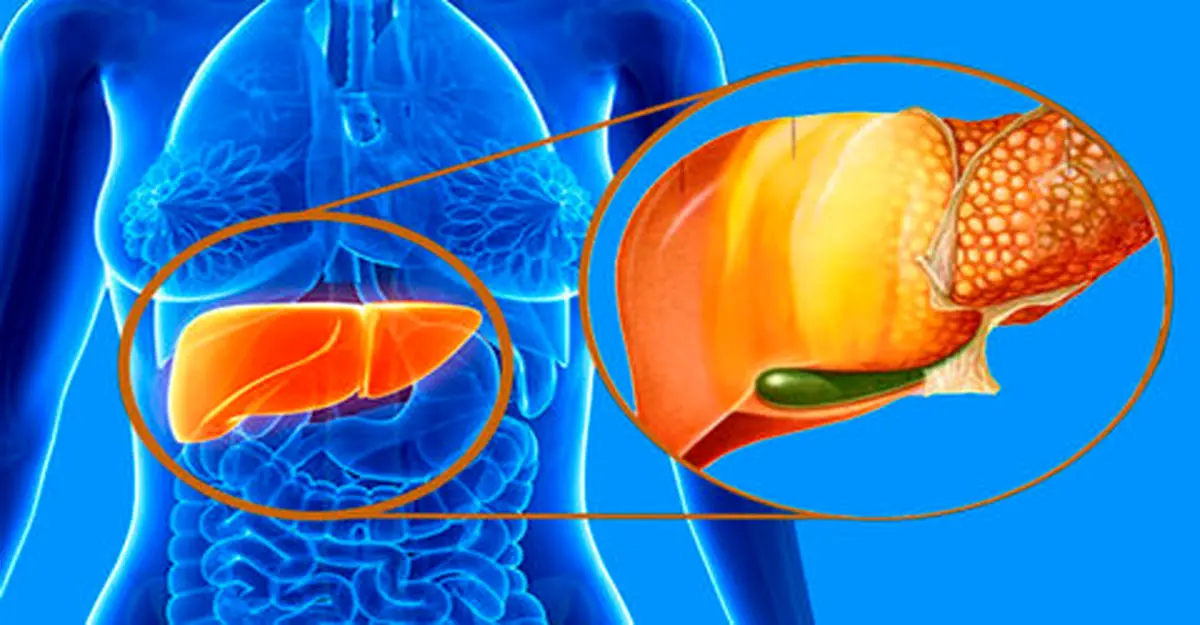 درمان کبدچرب با راهکارهای طبیعی