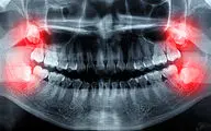 چند توصیه برای تسریع بهبودی پس از جراحی دندان عقل