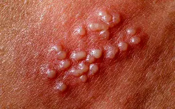 راه انتقال تبخال تناسلی مردان چیست؟