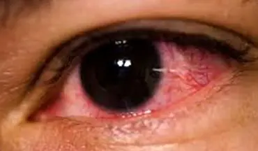 درمان‌های خانگی قرمزی چشم