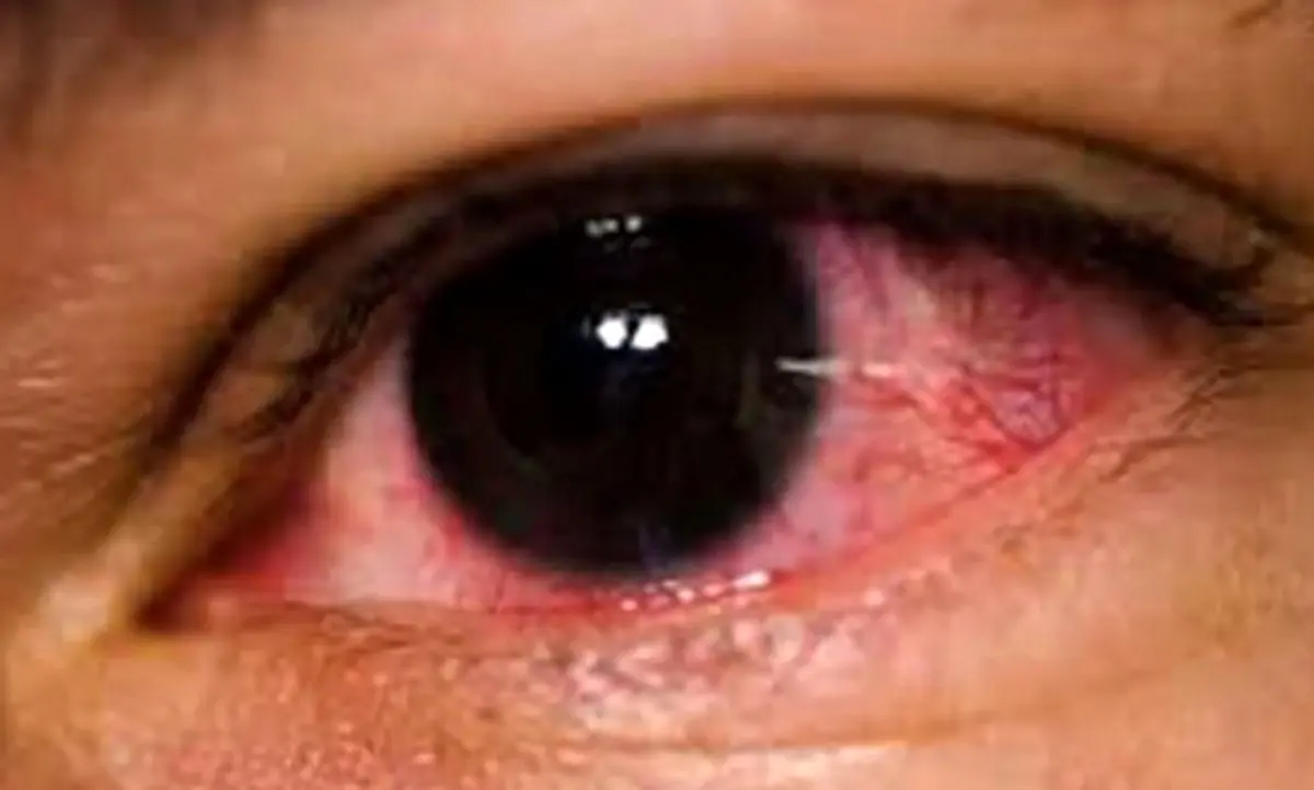 درمان‌های خانگی قرمزی چشم