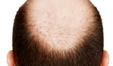 پیاز برای درمان طاسی سر؛10 روش موضعی برای تحریک رشد مو