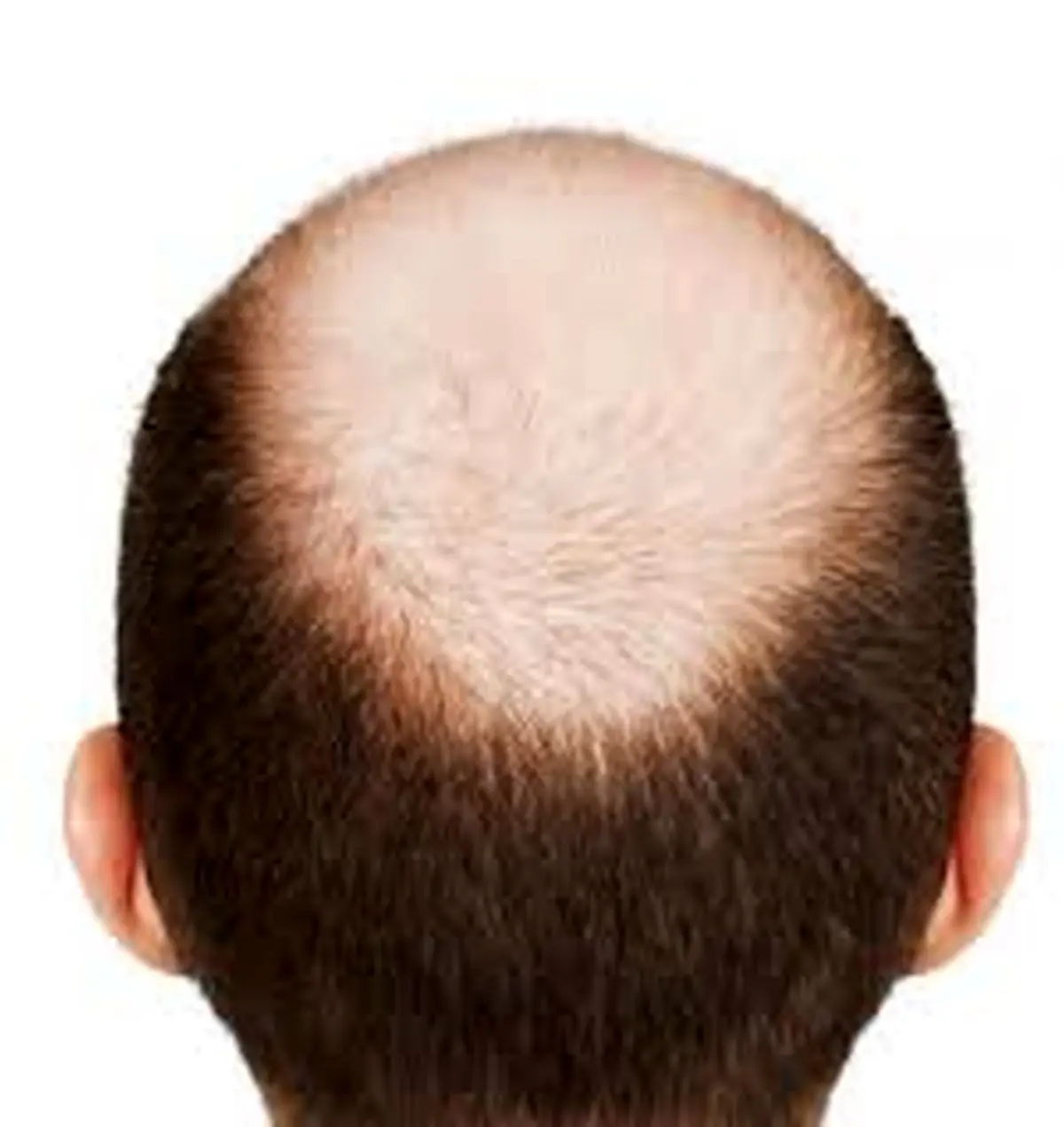 پیاز برای درمان طاسی سر؛10 روش موضعی برای تحریک رشد مو