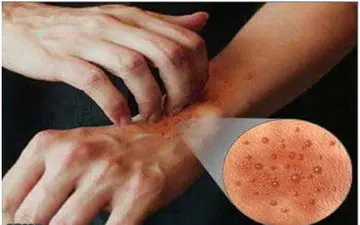 
درباره «اگزما» بیشتر بدانید
