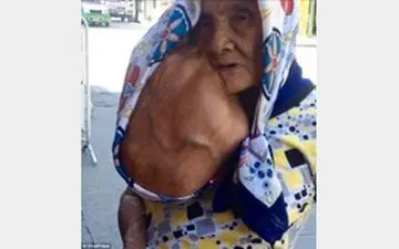 پیرزن فیلیپینی با توموری دوبرابر صورتش +تصاویر