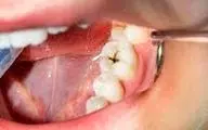داروهایی که موجب پوسیدگی دندان می‌شوند