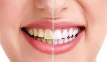 ارزان ترین راه برای سفیدی دندان و خوشبو شدن دهان