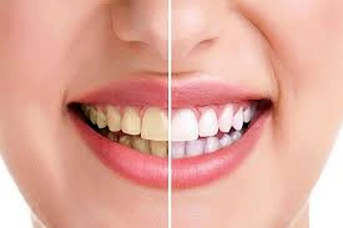 ارزان ترین راه برای سفیدی دندان و خوشبو شدن دهان