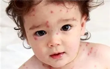 نگرانی جدید/زنگ خطر شیوع سرخک به صدا در آمد