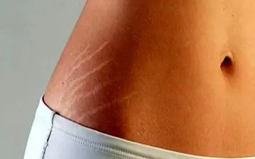 چطور ترک‌های پوستی را از بین ببریم؟