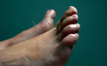 فواید طب سوزنی در درمان نقرس