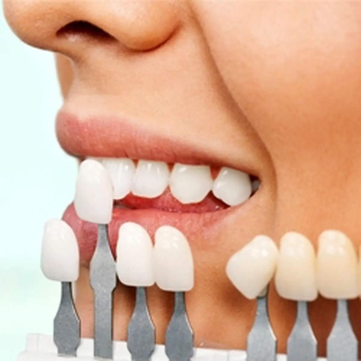 علل جدا شدن لامینیت از دندان چیست؟ 