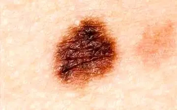 بهترین راه پیشگیری از شایع ترین سرطان!