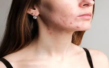 نکته‌هایی درباره مکمل‌ها برای جوش‌های هورمونی
