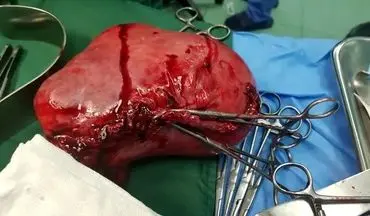 جراحی موفقیت‌آمیز برداشتن توده ۲ کیلویی در قم